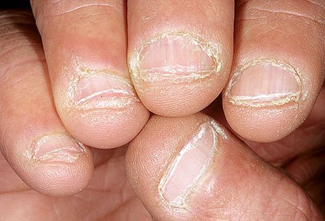 Nail biting or picking has  been linked to obsessive-compulsive disorder. Nail Disorders, Peeling Nails, Nail Problems, Nail Infection, Nail Biting, Toenail Fungus, Nail Fungus, Dry Nails, Nail Health