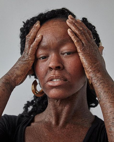 Woman Who Sheds Skin Every Two Weeks Becomes Probably The First Model Who Has This Condition | Bored Panda Black Motivation, Film Characters, Fabulous Women, Real Bodies, Skin Condition, Lots Of Makeup, Photographie Inspo, Homemade Face Masks, Beauty Standards