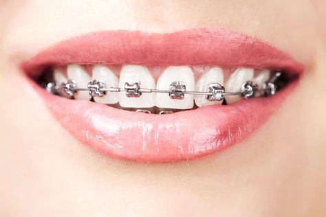 Damon Braces, Dental Wallpaper, Braces Cost, Adult Braces, Traditional Braces, Invisible Braces, Clear Braces, Braces Colors, Dental Braces