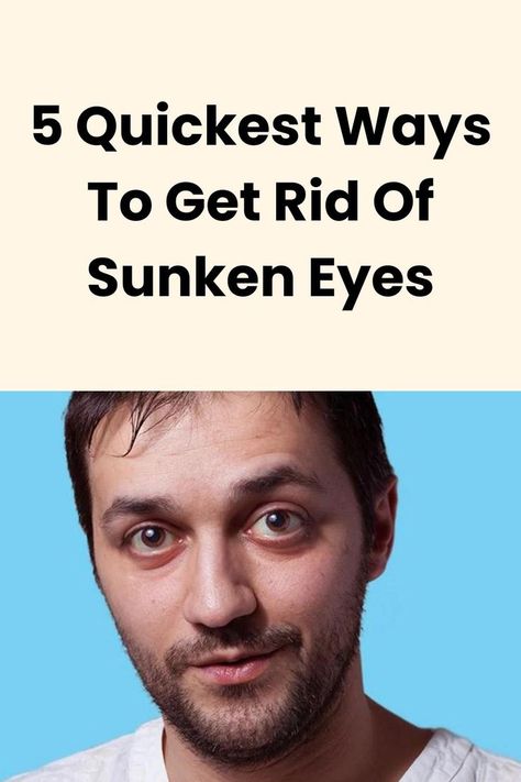 Sunk In Eyes Makeup, How To Get Rid Of Sunken Eyes, How To Get Rid Of Sunken Under Eyes, Sunken Under Eyes Remedies, Puffy Eyes Remedy How To Get Rid, Sunken Eyes Remedy, Sunken In Eyes, Sunken Under Eyes, Baggy Eyes Remedy