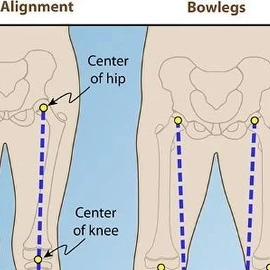 Back Pain | Neck Pain | Rehab on Instagram: "BOW LEGS VS KNOCK KNEES VS NORMAL KNEES  Do you have any of these conditions?   If yes, type "yes" and I will post about how to fix it.  #med #medicals #medicalknowledge #knowledgeispower📚 #knowledgable #knowlege #knowledgeofself #knowledgeispower #didyouknow #didyouknowfacts #facts #factsonfacts #dailypost #posts #postoftheday #day #days #read #reading #readmorebooks #teach #teacher #teachers #teachersofinstagram #teacherlife #teachergram #teacherstyle #human #humans #humaninterest  Which one do you have?" Workout For Knock Knees, Fix Knock Knees, Fixing Knock Knees, Yoga For Knock Knees, On Your Knees Meme, Knock Knees, Bow Legged, Leg Pain, Did You Know Facts