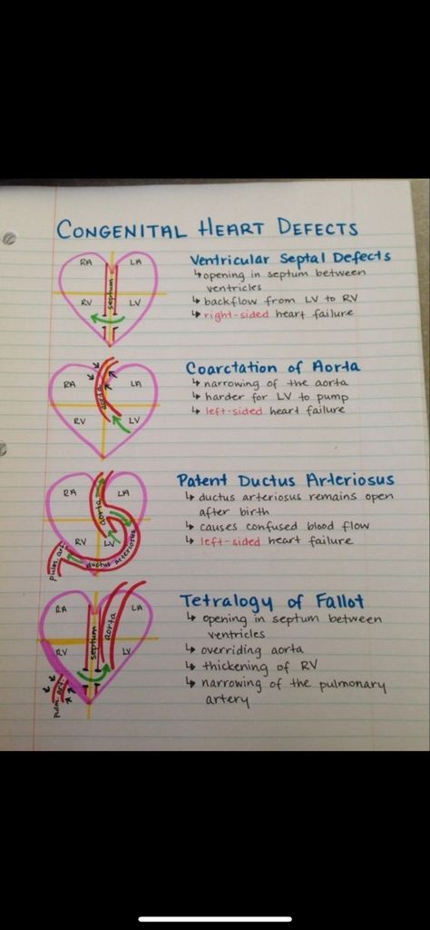 Patent Ductus Arteriosus Nursing, Patent Ductus Arteriosus, Ekg Rhythms, Nursing Cv, Atrial Septal Defect, Congenital Heart Defect, Heart Defect, Nursing School Survival, Congenital Heart