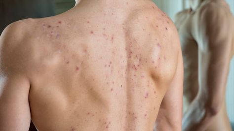 Cystic back acne: Causes and how to treat it What Causes Pimples, Back Acne Remedies, Back Acne, Greasy Skin, Acne Vulgaris, Severe Acne, Sweat Gland, Body Acne, Acne Causes