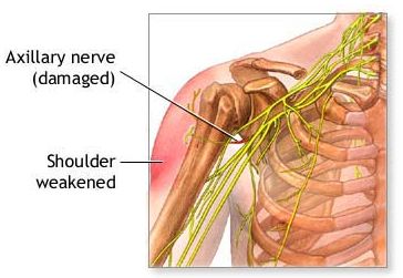 Nerve Flossing, Humerus Fracture, Teres Major, Trapped Nerve, Axillary Nerve, Brachial Plexus, Nerve Disorders, Shoulder Dislocation, Muscle Atrophy