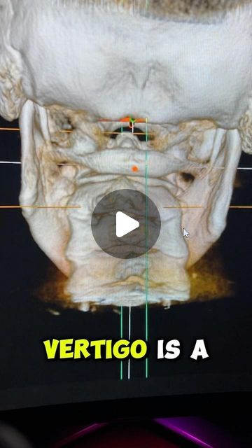 Lavender Family Chiropractic on Instagram: "Has anyone ever explained vertigo to you this way? 🤔 Let us know below 👇 #uccnearme #vertigo" Vertigo Relief Remedies, Epley Maneuver, Vertigo Causes, Vertigo Exercises, Vertigo Relief, Vertigo Remedies, Family Chiropractic, Spine Health, Sciatic Nerve Pain