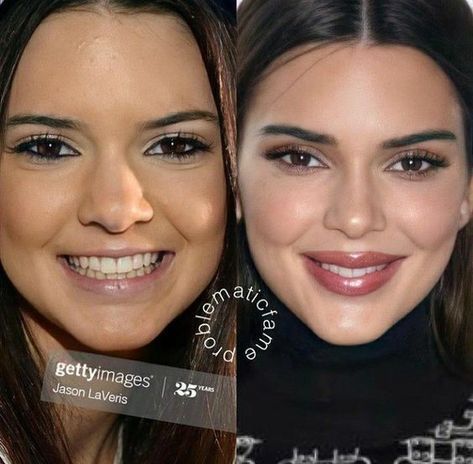 Kendall Jenner Plastic Surgeries, Kendall Jenner Nose, Kendall Jenner Nose Job, Kendall Jenner Plastic Surgery, Bulbous Nose, Plastic Surgery Fail, Nose Jobs, Rhinoplasty Nose Jobs, Face Surgery