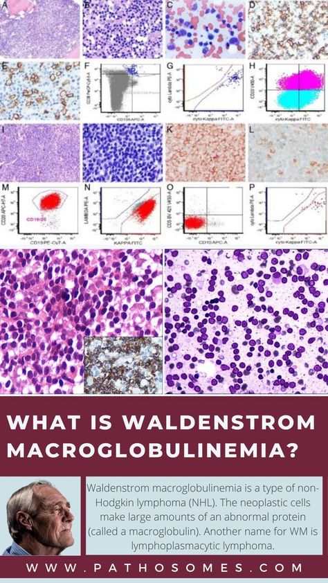 Waldenstrom Macroglobulinemia Non Hodgkin Lymphoma, Genetic, Nhl, Disease