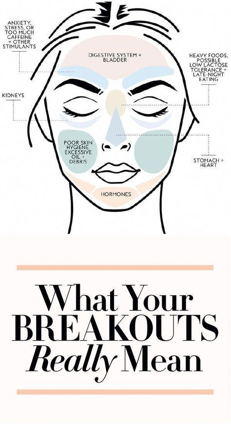 Face mapping may explain why you keep breaking out in the exact same spot on your face. Find out what face mapping is here. Clear Skin In A Week, Causes Of Acne, Cystic Acne Remedies, Acne Routine, Remedies For Acne, Acne Overnight, Face Mapping, Acne Skincare Routine, Natural Acne Remedies