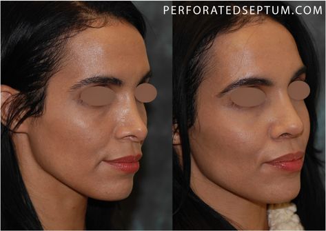 saddle nose deformity Rhinoplasty Recovery, Nasal Obstruction, Nasal Septum, Neck Surgery, Facial Plastic Surgery, Facial Plastic, Nose Job, Success Rate, Women Life