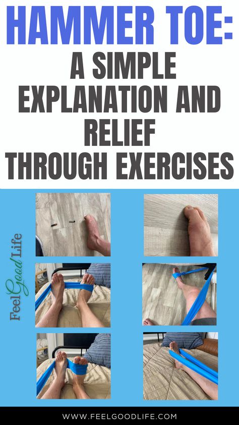 Hammer toe causes a toe to bend uncomfortably, leading to pain and walking difficulties. Find relief with exercises aimed at stretching and strengthening toe muscles, enhancing flexibility, and easing discomfort. Click for simple exercises to manage hammer toe effectively. #HammerToe #FootExercises #PainRelief #ToeFlexibility Hammertoe Remedies, Hammer Toe Correction, Essex Boys, Toe Exercises, Cucumber Benefits, Morton's Neuroma, Toe Straightener, Foot Exercises, Muscle Imbalance