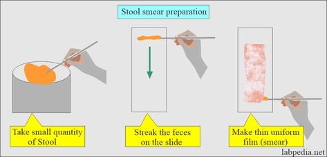 Normal Stool Examination Sample  The fresh stool can be examined immediately for the moving organisms. Stool in 10% formalin can be used for Helminths and protozoa. Stool in formalin-ethyl acetate is used to concentrate the stool. The smallest amount of stool needed for the examination is 2 to 5 grams. For ova and parasites, there are three methods: Direct stool examination. Concentration method. The permanent stain of the stool. Precautions for stool examin... Stool Sample, High Blood Sugar Symptoms, Vegetable Diet, Bile Duct, White Blood Cells, Large Intestine, Bacterial Infection, Blood Cells, Stain