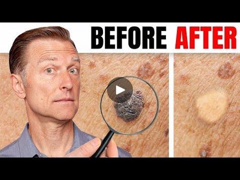 How to Remove Skin Tags and Warts Overnight - Dr. Berg Explains - Dr. Eric Berg DC | How to Remove Skin Tags and Warts Overnight - Dr. Berg Explains - Dr. Eric Berg DC | By Dr. Eric Berg DCFacebook Skin Tags What Causes, Face Warts, Skin Tags On Face, Remove Moles, Remove Skin Tags, Mole Removal, Eric Berg, Get Rid Of Warts, Dr Berg