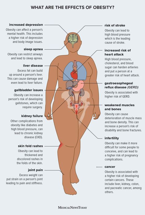 Obesity Help, Obesity Awareness, Obese Workout, Health Facts Food, Liv Pure, Obese People, Weight Problems, Reduce Body Fat, Sensitive People