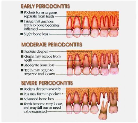 What Is Oil Pulling? How A Healthy Mouth Can Mean a Healthy Results for the Body What Is Oil Pulling, Mouth Hygiene, Dental Assistant Study, Healthy Mouth, Sensitive Teeth Remedy, Remedies For Tooth Ache, Swollen Gum, Kedokteran Gigi, Dental Hygiene School