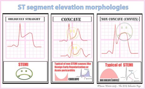 ST Segment Elevation Morphologies #Diagnosis #Cardiology ... St Elevation, Paramedic School, Nurse Practitioner School, Medical Mnemonics, Medical School Life, Cardiac Nursing, Nursing Study, Med Student, Cardiovascular System