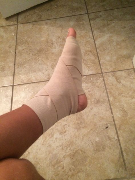 How to Sprained Leg Snapchat, Leg In A Cast, Leg Accident Real Pic For Women, Ankle Sprain Pictures, Hand Fracture Fake Story, Leg Fracture Snapchat Story, Ankle Injury Snapchat, Fracture Snap, Leg Fracture Photos