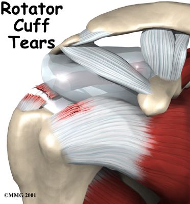 Rotator Cuff Tear Shoulder Blade Muscles, Shoulder Anatomy, Rotator Cuff Surgery, Rotator Cuff Tear, Rotator Cuff Injury, Shoulder Training, Shoulder Surgery, Frozen Shoulder, Shoulder Injuries