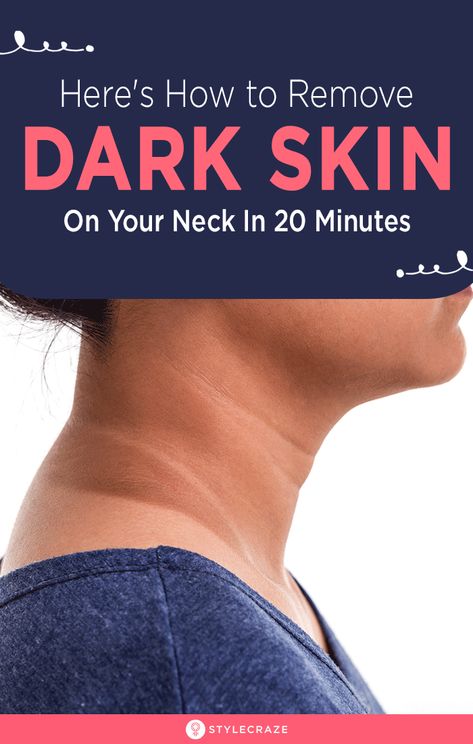 How To Remove Dry And Dark Skin On Your Neck In 20 Minutes: The darkening of the skin on the neck could be due to a lot of reasons. Sun exposure could be one of the main reasons, but it could also be due to a specific health concern such as insulin resistance. For those of us who have just been negligent with sunscreens, here are some easy remedies to gradually lighten those patches on your neck. #Remedies #HomeRemedies #DarkNeck #SkinCare Dark Skin Around Neck, Dark Neck Remedies, Skin Lightening Diy, Blind Pimple, Pimples Under The Skin, Skin Darkening, Tan Removal, Skin Shine, Moisturizer For Oily Skin