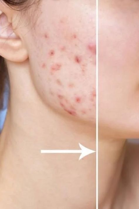 Expert Guide to Clear Skin Different Types Of Acne, Moderate Acne, Diy Beauty Treatments, Natural Acne Remedies, Severe Acne, Types Of Acne, Acne Remedies, Cruelty Free Skin Care, Improve Skin Texture