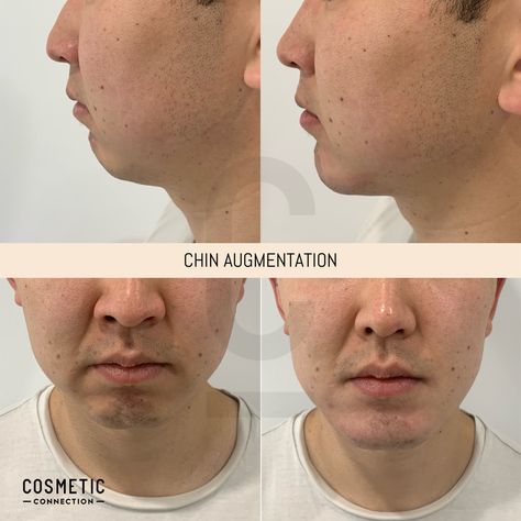 Chin injections are a non surgical way to change the shape of the chin. If you have noticed that your chin is small, recessed or flat, and lacking a bulky, angular and masculine appearance, then chin injections with dermal fillers are a safe and quick way to add structure and definition to your chin. If you're interested in a Chin Augmentation then contact the team at Cosmetic Connection to discuss more. Confidence looks good® Recessed Chin, Chin Augmentation, More Confidence, Dermal Fillers, Beautiful Makeup, Square Sunglasses Men, It Works, Take That, Makeup