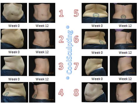 Take a look at her Before & After with #CoolSculpting!! Cool Sculpting Before And After, Coolsculpting Before And After, Cool Sculpting, Exercise Tips, Fat Reduction, Get Healthy, Fitness Tips, Health Tips, Take A