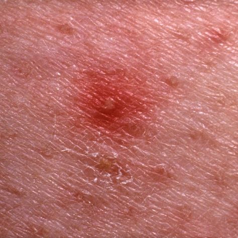 Skin, Peach, Pink, Close-up, Flesh, Itchy Bumps On Skin, Red Spots On Skin, Red Skin Spots, Skin Bumps, Skin Spots, Bug Bites, Brown Spots, Peach Pink, Skin Conditions