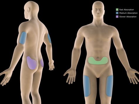 ICYMI: Administering Vitamin B12 Shots: B12 Injection Sites @InvigorM #blogengage Insulin Injection Sites, Insulin Injection, Injection Sites, Vitamin B12 Injections, B12 Shots, Subcutaneous Injection, B12 Injections, B12 Deficiency, Vitamin B12 Deficiency