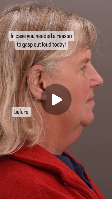 Quatela Center for Plastic Surgery on Instagram: "There is no caption that could speak louder than these images! This is LIFE CHANGING!  Surgery: facelift with deep neck work, temporal lift, upper and lower eyelid lift  Surgeon: World Renowned Double Board Certified Facial Plastic Surgeon Dr. Vito Quatela   #facelift #faceliftsurgery #faceliftspecialist #faceliftexpert #faceliftbeforeandafter #deepplanefacelift #naturalfacelift #lifechanging #plasticsurgery #plasticsurgeon" Upper Eyelid Lift Surgery, Lower Face Lift Before And After, Neck Lift Before And After, Pdo Thread Lift Before And After, Plastic Surgery Before And After, Lip Lift Surgery, Double Chin Surgery, Plastic Surgery Video, Facelift Recovery