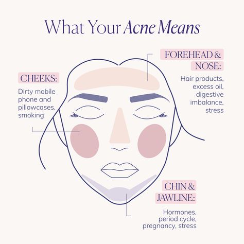 What Causes Pimples, Face Mapping Acne, Blind Pimple, Prevent Pimples, Pimples Under The Skin, Skin Facts, Pimples On Face, Skin Advice, Face Mapping