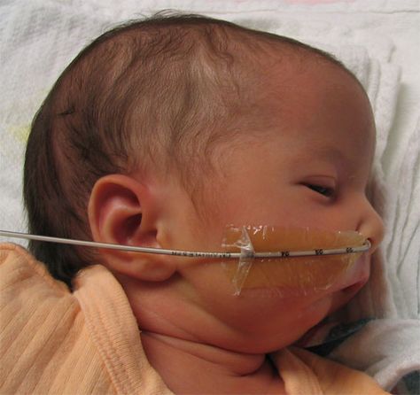 Micrognathia, or "small jaw", can often be best appreciated when looking at the profile of the infant. While many infants may appear to have a slightly recessed chin, the appearance above is clearly abnormal. Underlying genetic conditions should be considered in cases such as this; there are quite a few chromosomal conditions associated with this finding. Recessed Chin, Newborn Nursery, Rad Tech, System Administrator, Medical Field, Medical School, Genetic, Infants, Pediatrics