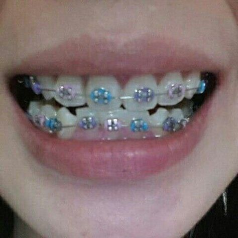 Light Blue Braces Teeth, Purple And Blue Braces, Braces Light Blue, Pink And Blue Braces, Violet Braces, Light Purple Braces, Lilac Braces, Star Braces, Sky Blue Braces