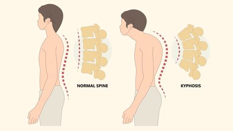 How to Fix Neck Hump: 8 Exercises for "Tech Neck" Exercises For Tech Neck, How To Fix Neck Hump, Fix Neck Hump, Pectoral Stretches, Primal Movement, Neck Hump, Chin Tuck, Tech Neck, Tight Hamstrings