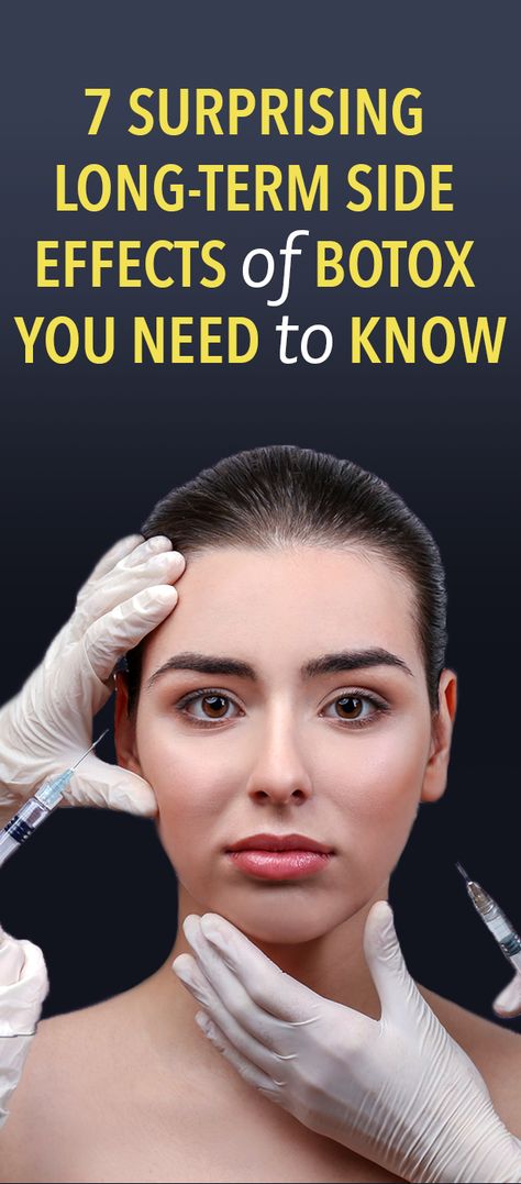 7 Surprising Long-Term Side Effects Of Botox You Need To Know Botox Forehead, Botox Results, Natural Botox, Botox Before And After, Face Fillers, Vaseline Beauty Tips, Botox Alternative, Korean Beauty Tips, Botox Face