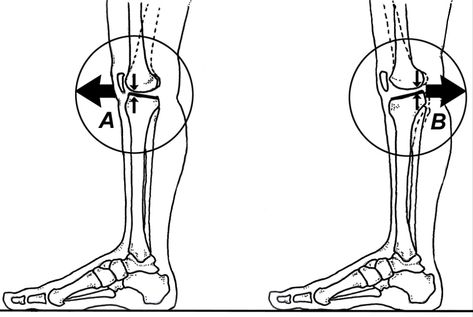 Gait Retraining for Knee Hyperextension - Human Locomotion Hyperextended Knee, Physio Therapy, Osgood Schlatter Disease, Gastrocnemius Muscle, Anterior Cruciate Ligament, Referred Pain, Ligament Tear, Spinal Nerve, Tight Hamstrings