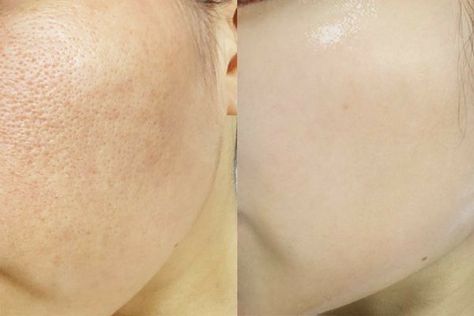 Micronidelling Face, Facial Before And After, Skin Poster, Skin Facts, Best Acne Products, Face Pores, Dark Spots On Face, Beauty Tips For Face, Healthy Skin Tips