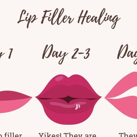 Demetria Whisenhunt on Instagram: "The healing phases of lip filler. It can take up to 2 weeks for your lips to fully heal after having injections. 💉 Days 1-3: Most intense swelling and bruising Days 4-7: Still swollen and possibly bruised but not as bad (most people love the lip swell) Days 8-13: They seem perfect! Most lumps/ bumps have gone away and bruising subsides. Days 14+: I love my lips 🥰 OR I need more filler 💋 This amazing patient allowed me to use her Befores and Afters to demonstrate the healing process! I used one full syringe of Juvederm Ultra to enhance her already luscious lips by emphasizing more on her bottom lip, creating a pouty lip shape." Lip Filler Gone Wrong, Lip Fillers Healing Process, Healed Lip Filler, Bruising After Lip Filler, Lip Fillers Inspiration, Lip Filler Swelling Day By Day, Bottom Lip Filler, Lips Fillers Shapes, Lip Filler Journey