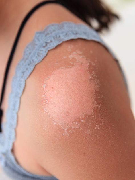 Why Your Skin Peels After a Sunburn, According to Dermatologists | Allure Sunburn Peeling, Sunburn Skin, Sunburn Remedies, Face Peel, Sun Burn, Peeling Skin, Lint Roller, Skin Remedies, Sun Damage