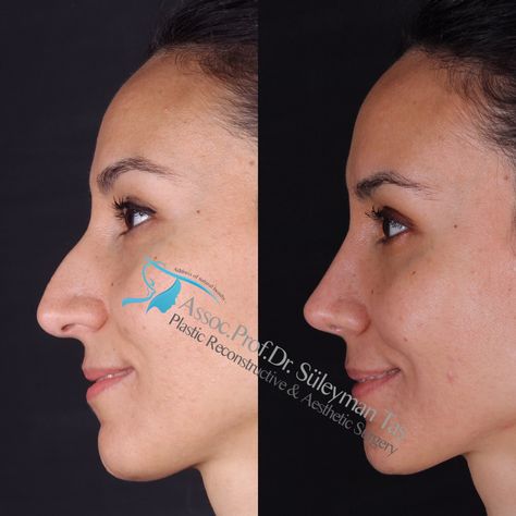 Ear Surgery Before And After, Nose Job Before And After Front View, Rhinoplasty Results, Nose Plastic Surgery Before After, Nose Job Natural, Rynoplasty Surgery, Nose Surgery Before And After, Nose Tip Surgery Before After, Nose Job Before And After Rhinoplasty