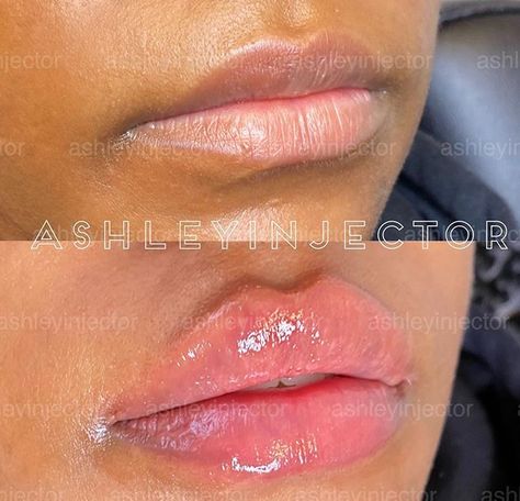 Pouty Lip Filler, Cosmetic Aesthetic, From Rags To Riches, Rags To Riches, Lip Filler, Lip Injections, Perfect Lips, Natural Lip, Upper Lip