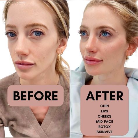 Before And After Cheek Filler, Mid Face Filler, Cheek Filler Before And After, Face Lift Before And After, Chin Botox Before And After, Face Fillers Before And After, Face Balancing Fillers, Fillers Before And After, Cheek Fillers Before And After Face