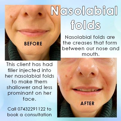 Nasolabial Folds Filler, Smile Line Filler, Smile Lines Filler Before And After, Filler Nasolabial Folds, Nasolabial Fold Filler, Botox Eleven Lines, .5 Syringe Lip Filler, Laser Clinics, Smile Lines