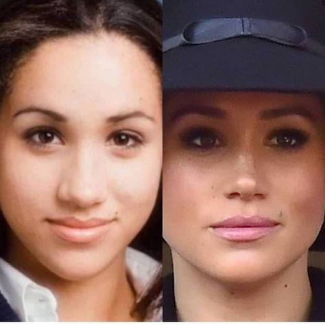 Megan Markle Nose, Meghan Markle Nose Job, Kpop Plastic Surgery, Jaw Reduction Surgery, Nose Plastic Surgery, Bad Celebrity Plastic Surgery, V Line Surgery, Plastic Surgery Fail, Nose Types