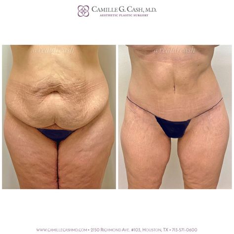 Lower Body Lift Surgery Before And After, Lower Body Lift Surgery, Tummy Tucks Before And After, Body Lift Surgery, Tummy Tucks Recovery, Mommy Makeover Surgery, Lap Band, Excess Skin, Mommy Makeover