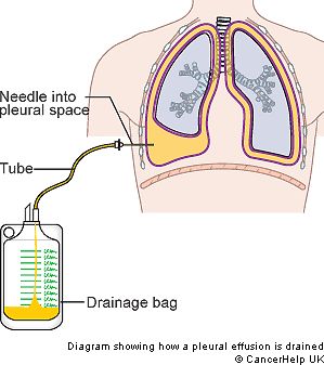 M.Tb pleural effusions show ALL lymphocytes and NO mesothelial cells. Classic. Nurse Skills, Nurse Teaching, Pleural Effusion, Nurse Training, Nursing Mnemonics, Pulmonology, Respiratory Therapy, Nursing Tips, Nursing Career