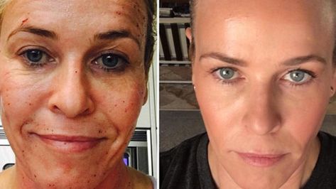 Profractional Laser, Skin Mask Diy, Scar Remedies, Acne Scar Mask, Laser Resurfacing, Diy Acne, Chelsea Handler, Acne Scar Removal, Skin Resurfacing