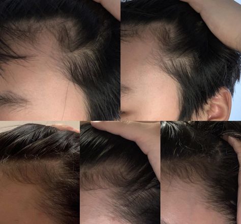 Does this look like its getting better? The top one was taken 2 months ago and the three bottom ones were recent. Im 14 and it looks like a receding hairline in my opinion because of the rounded edge of my hairline and the way it slightly curves upwards to the top on the top left corner picture Round Hairline, Taken 2, Widow's Peak, Receding Hairline, Getting Better, 2 Months, Behind Ear Tattoo, The Top, Vision Board