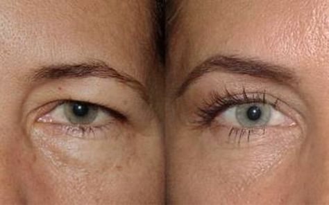 The Real Deal with Brow Lifts - Dr. Guy Massry Eyebrow Lift Surgery, Eye Lift Surgery, Endoscopic Brow Lift, Brow Lift Surgery, Botox Brow Lift, Eyebrow Lift, Eyelid Lift, Facial Plastic Surgery, Upper Eyelid