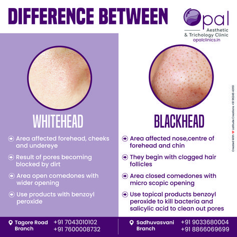 🔍✨ Spot the difference between blackheads and whiteheads with Opal Clinic! 🌟 Knowing the difference helps you choose the right treatments and products for clear, beautiful skin! 💁‍♀️💖 Like, Share and Follow us for more skincare tips! Opal Clinic Rajkot, Gujarat #SkinCareMagic #BlackheadRemoval #WhiteheadTreatment #OpalClinic #ClearSkin #SkinCareSolutions #HealthySkin #BeautyCare #Dermatology #SkinCare #Blackheads #Whiteheads Skincare Blackheads, Blackheads And Whiteheads, Learn Yoga Poses, Cleaning Your Ears, Learn Makeup, Dermatological Skin Care, Spot The Difference, Cleanse Recipes, Get Rid Of Blackheads