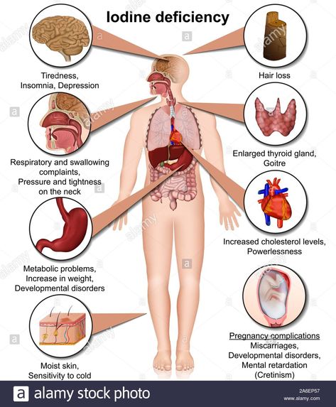 Download this stock vector: Iodine deficiency 3d medical vector illustration isolated on white background eps 10 infographic - 2A6EP57 from Alamy's library of millions of high resolution stock photos, illustrations and vectors. Vitamin B3 Deficiency, Foods With Iodine, Vitamin B Deficiency, Medical Vector, Iodine Supplement, Thyroid Recipes, Iodine Deficiency, Deficiency Symptoms, Vitamin B2