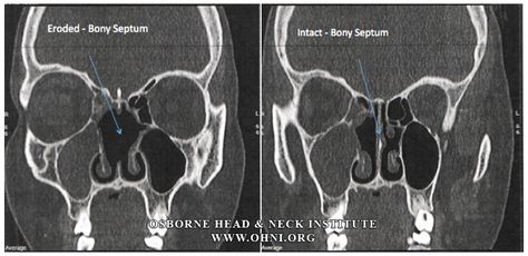 Granuloma Annulare, Wegeners Granulomatosis, Septo Optic Dysplasia, Deficiency Diseases, Creutzfeldt Jakob Disease, Pituitary Adenoma Awareness, Autoimmune Disorder, Blood Vessels, Autoimmune Disease